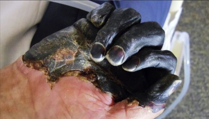 bubonic-plague-China